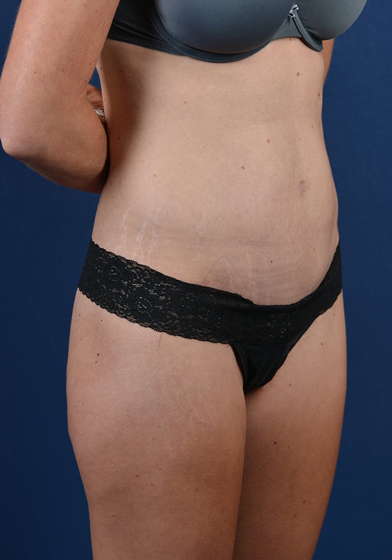 Abdominoplasty Before & After Gallery - Patient 9276097 - Image 6