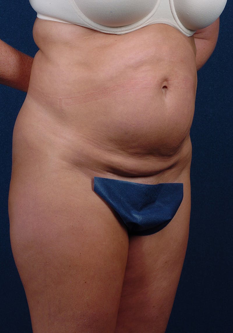 Abdominoplasty Before & After Gallery - Patient 9276101 - Image 5