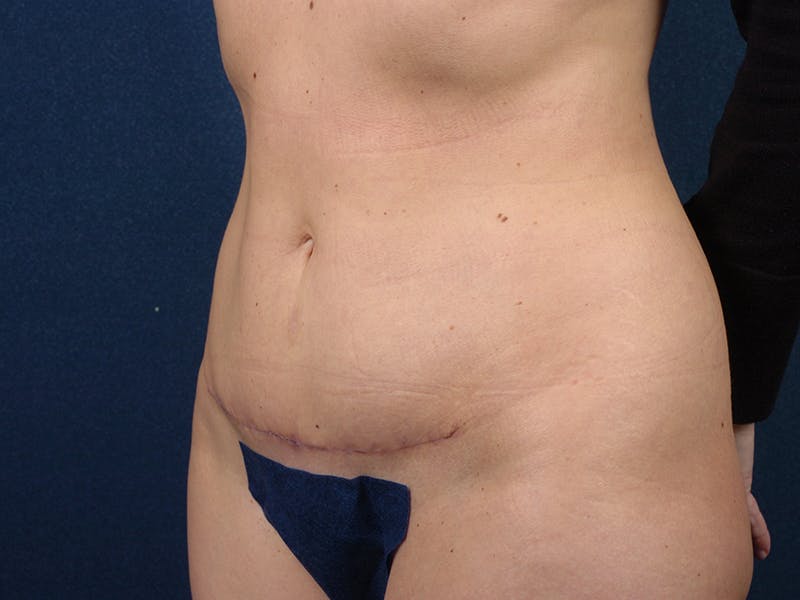 Abdominoplasty Before & After Gallery - Patient 9276104 - Image 4