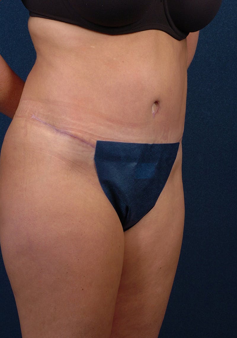 Abdominoplasty Before & After Gallery - Patient 9276101 - Image 6