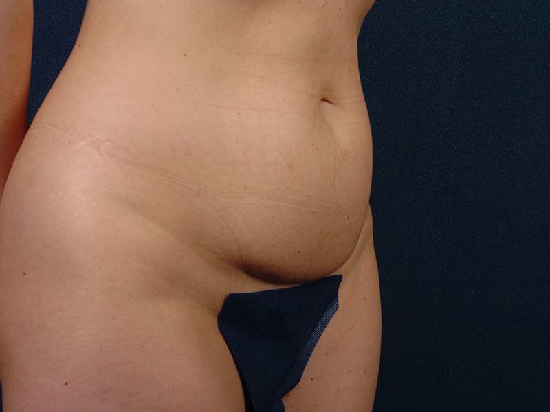 Abdominoplasty Before & After Gallery - Patient 9276104 - Image 5