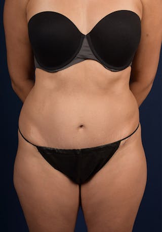Abdominoplasty Before & After Gallery - Patient 377212 - Image 2