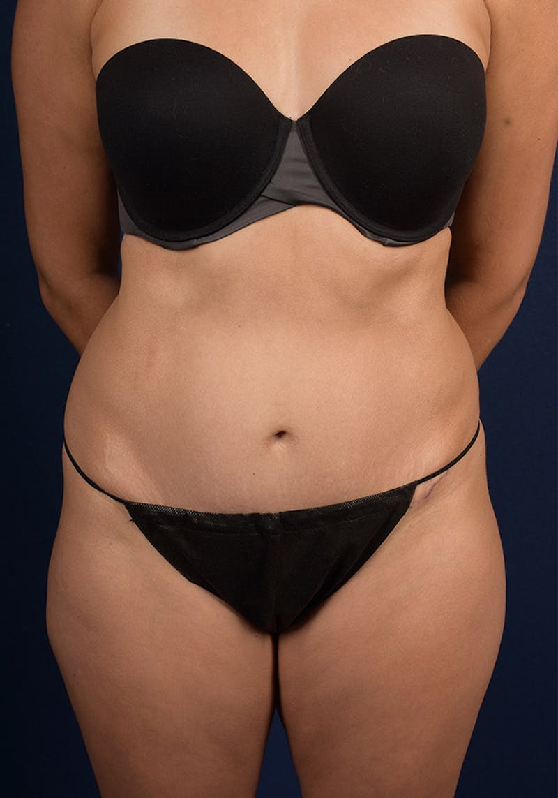 Abdominoplasty Before & After Gallery - Patient 9286752 - Image 2