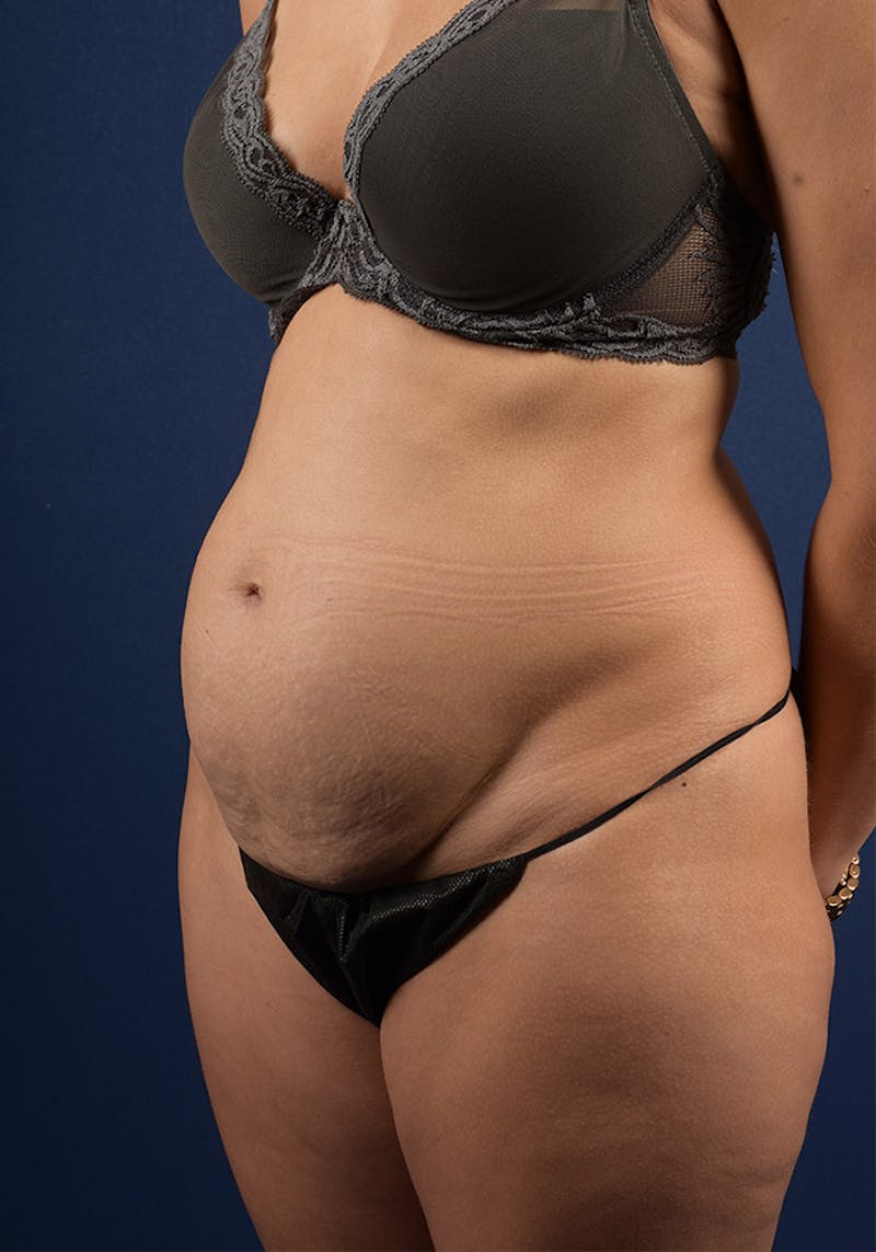 Abdominoplasty Before & After Gallery - Patient 9286752 - Image 3