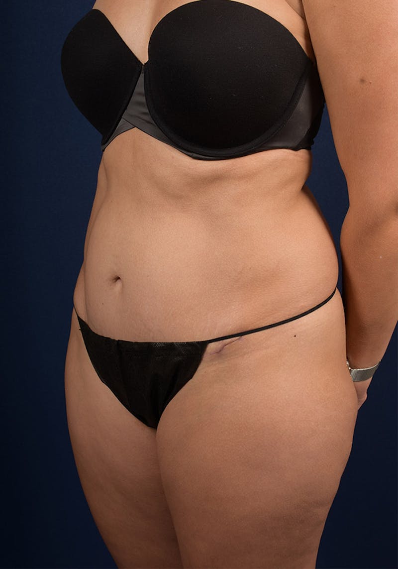 Abdominoplasty Before & After Gallery - Patient 9286752 - Image 4