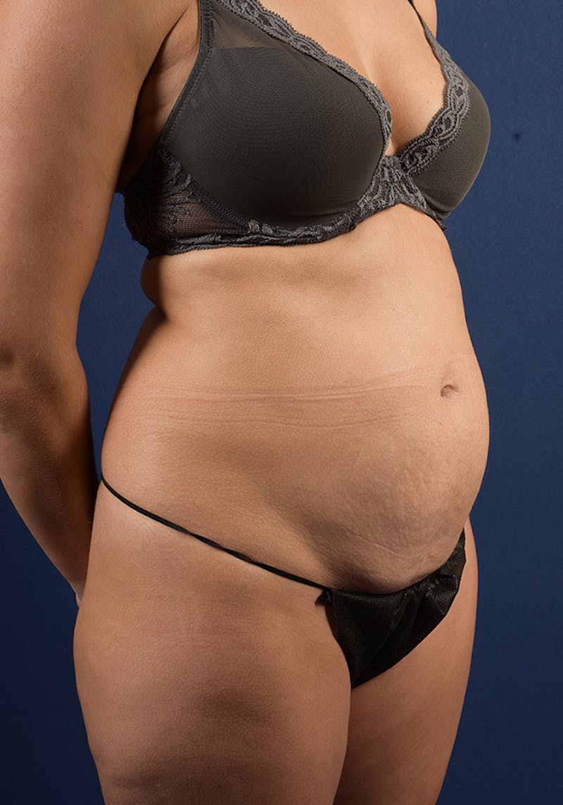 Abdominoplasty Before & After Gallery - Patient 9286752 - Image 5