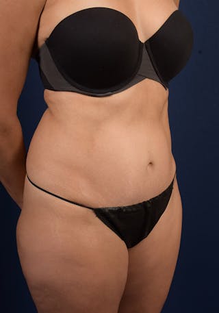 Abdominoplasty Before & After Gallery - Patient 377212 - Image 6