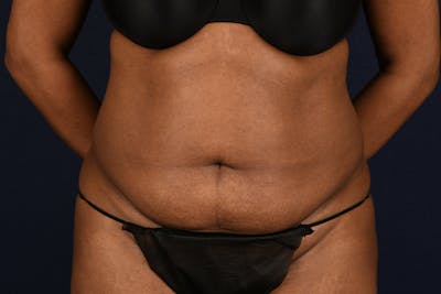 Abdominoplasty Before & After Gallery - Patient 243966 - Image 1