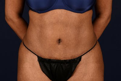 Abdominoplasty Before & After Gallery - Patient 243966 - Image 2