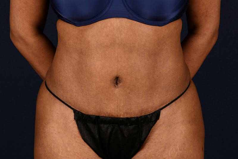 Abdominoplasty Before & After Gallery - Patient 9286760 - Image 2