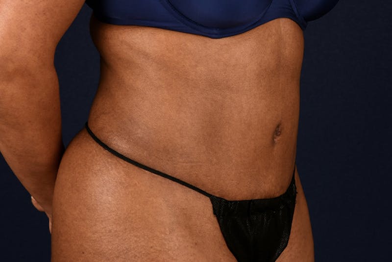 Abdominoplasty Before & After Gallery - Patient 9286760 - Image 4