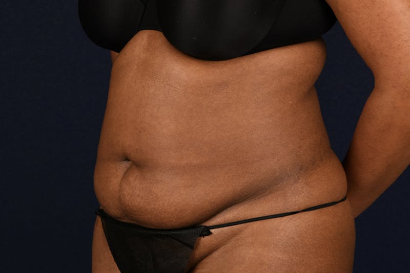 Abdominoplasty Before & After Gallery - Patient 9286760 - Image 5
