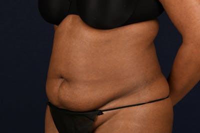 Abdominoplasty Before & After Gallery - Patient 243966 - Image 5