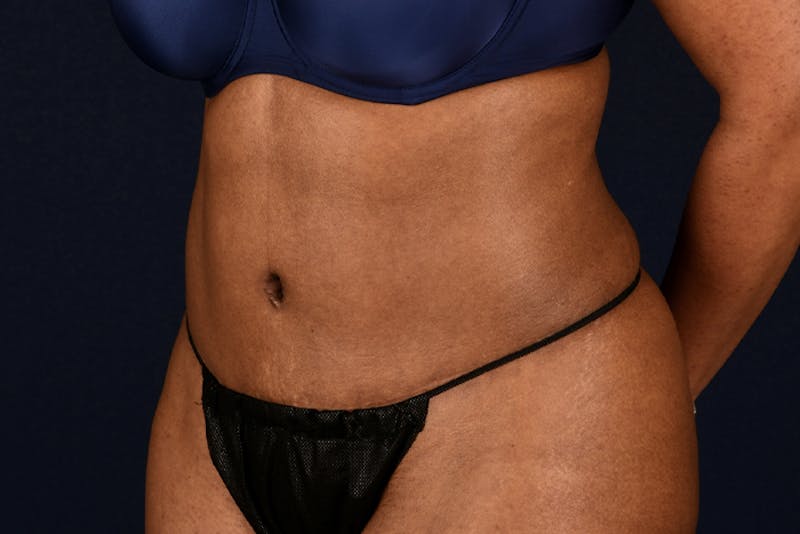 Abdominoplasty Before & After Gallery - Patient 9286760 - Image 6
