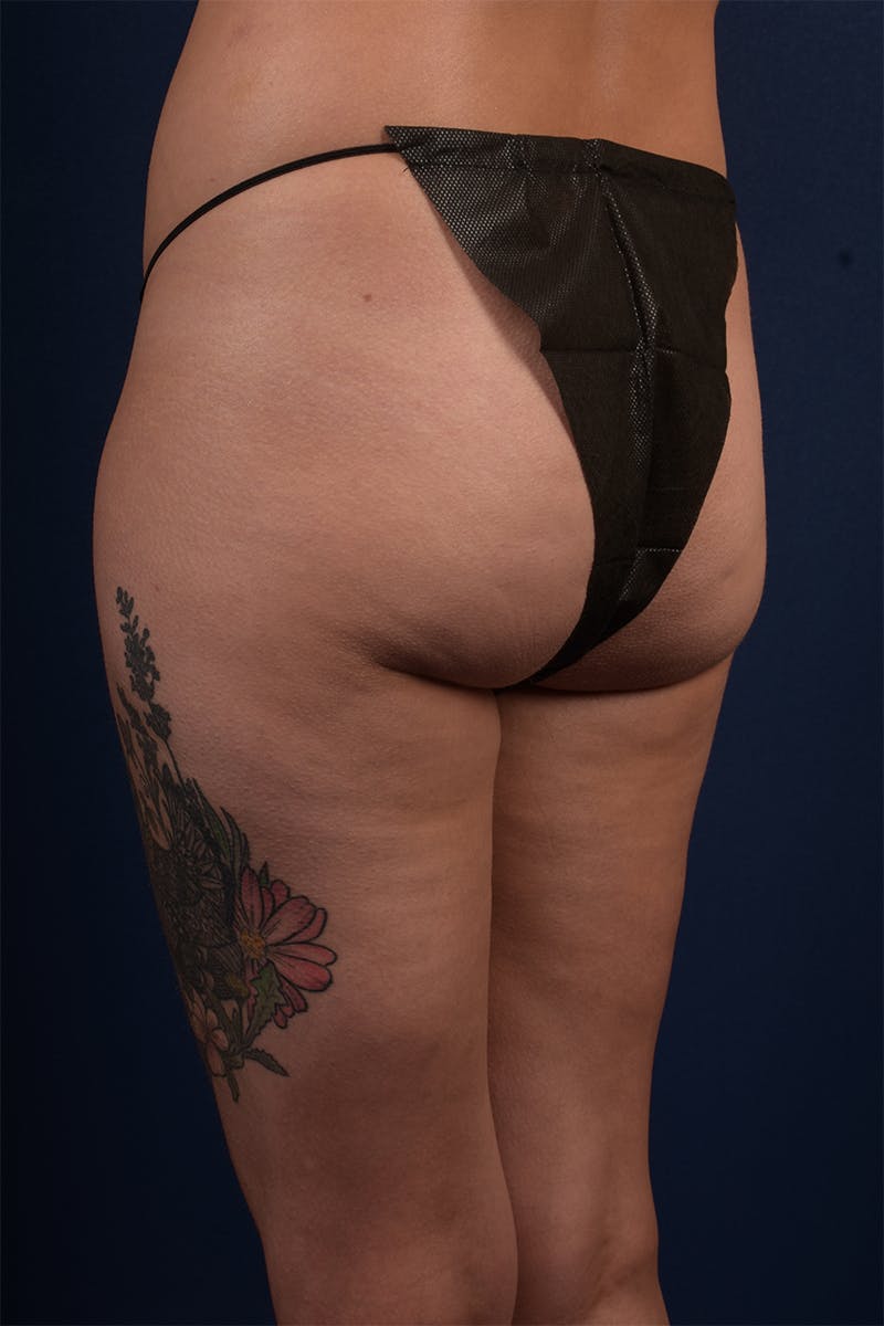 Brazilian Buttock Lift Before & After Gallery - Patient 9421655 - Image 3