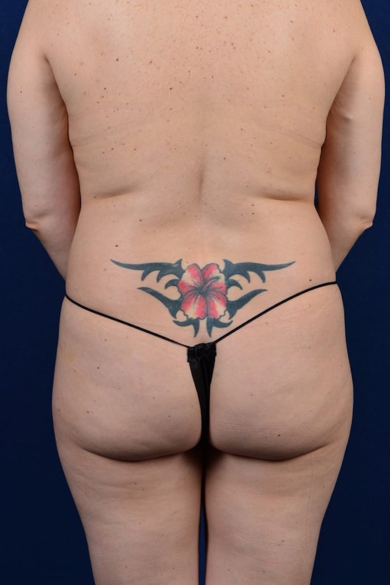 Brazilian Buttock Lift Before & After Gallery - Patient 9421658 - Image 1