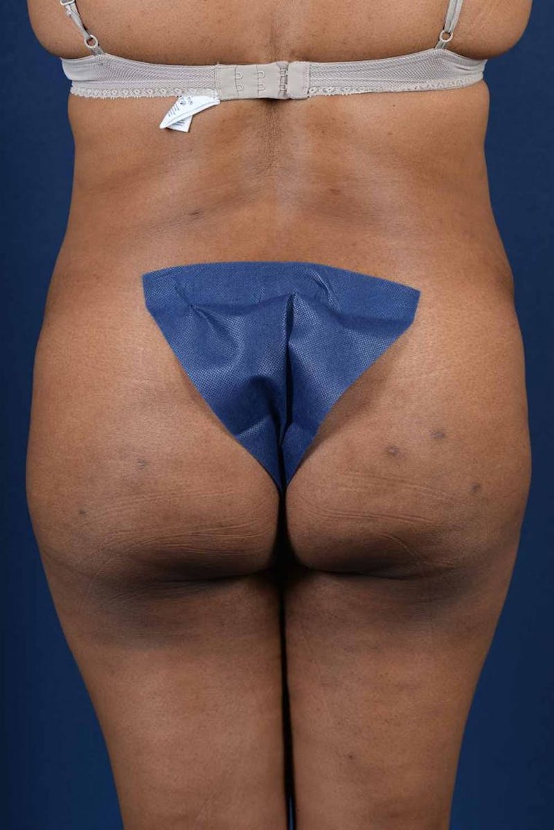 Brazilian Buttock Lift Before & After Gallery - Patient 9421662 - Image 2