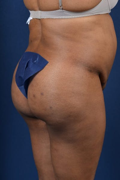 Brazilian Buttock Lift Before & After Gallery - Patient 9421662 - Image 4