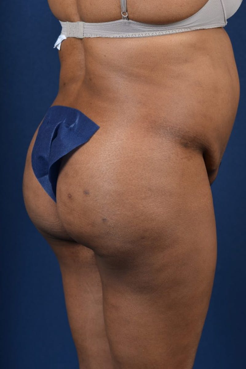 Brazilian Buttock Lift Before & After Gallery - Patient 9421662 - Image 4