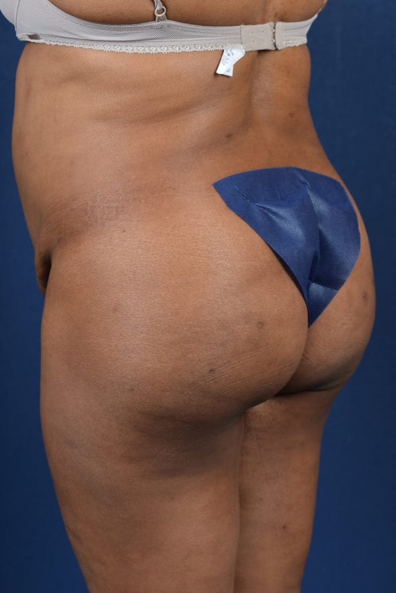 Brazilian Buttock Lift Before & After Gallery - Patient 9421662 - Image 6