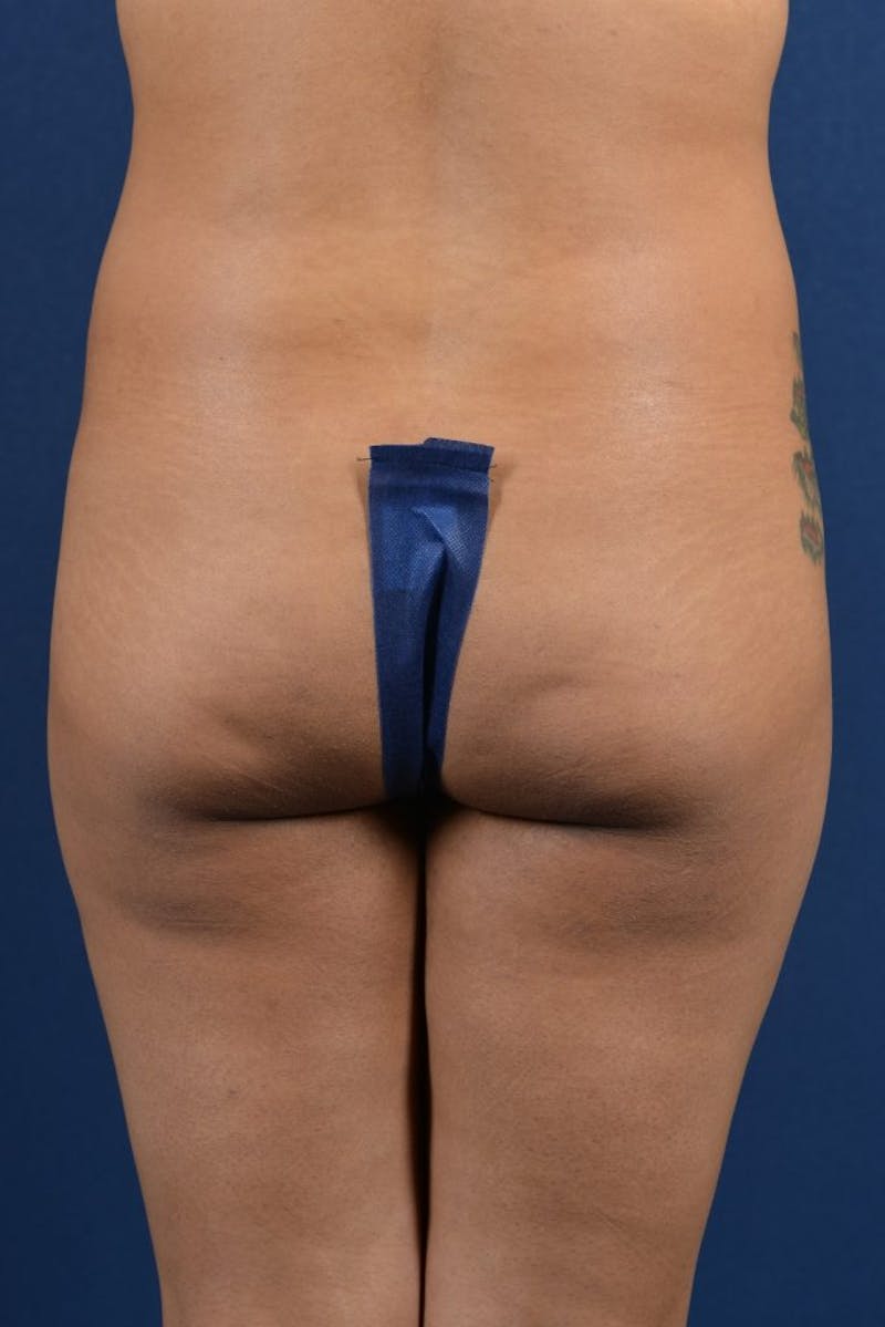 Brazilian Buttock Lift Before & After Gallery - Patient 9421663 - Image 1