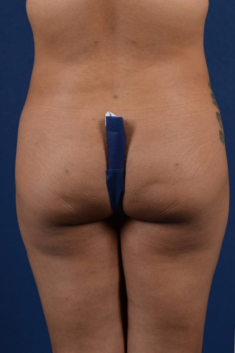 Brazilian Buttock Lift Before & After Gallery - Patient 9421663 - Image 2
