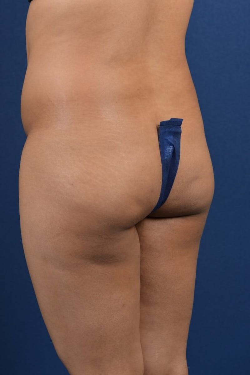 Brazilian Buttock Lift Before & After Gallery - Patient 9421663 - Image 3