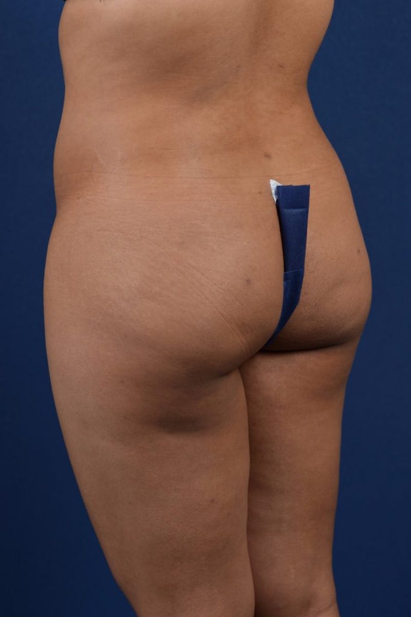Brazilian Buttock Lift Before & After Gallery - Patient 9421663 - Image 4
