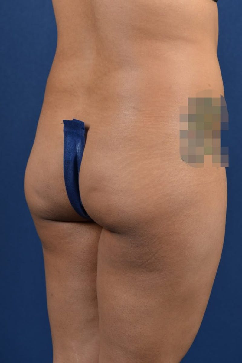 Brazilian Buttock Lift Before & After Gallery - Patient 9421663 - Image 5
