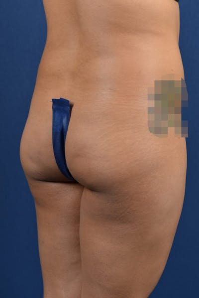 Brazilian Buttock Lift Before & After Gallery - Patient 9421663 - Image 5