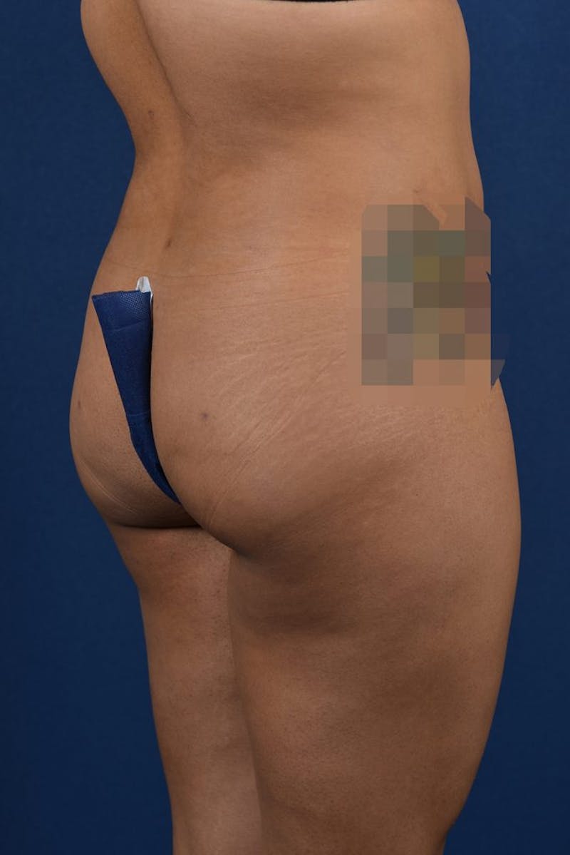 Brazilian Buttock Lift Before & After Gallery - Patient 9421663 - Image 6