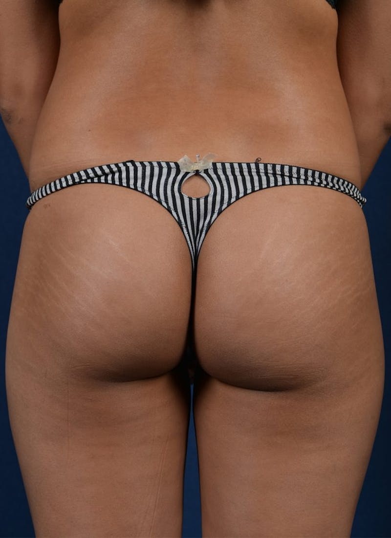 Brazilian Buttock Lift Before & After Gallery - Patient 9421667 - Image 1