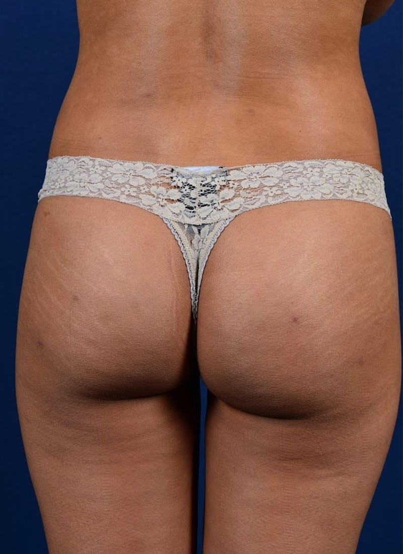 Brazilian Buttock Lift Before & After Gallery - Patient 9421667 - Image 2