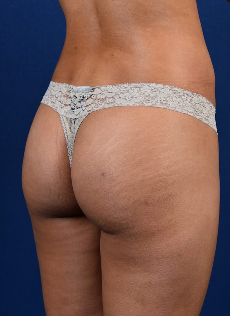 Brazilian Buttock Lift Before & After Gallery - Patient 9421667 - Image 4