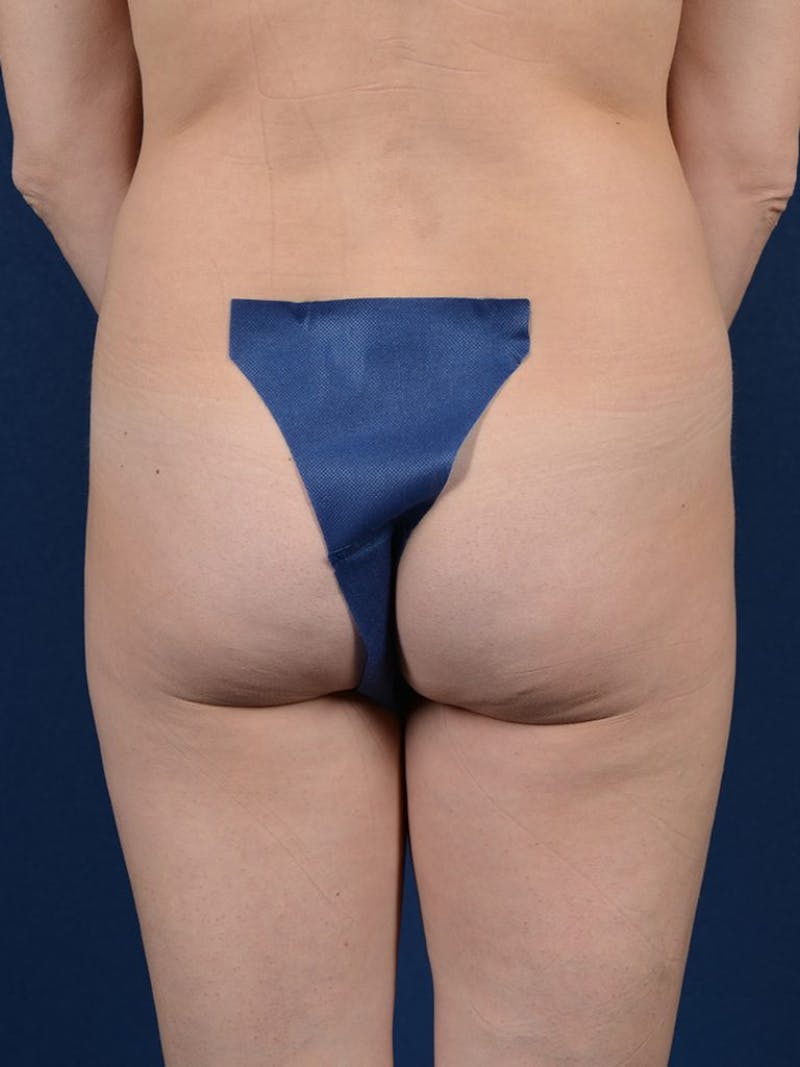 Brazilian Buttock Lift Before & After Gallery - Patient 9421668 - Image 1