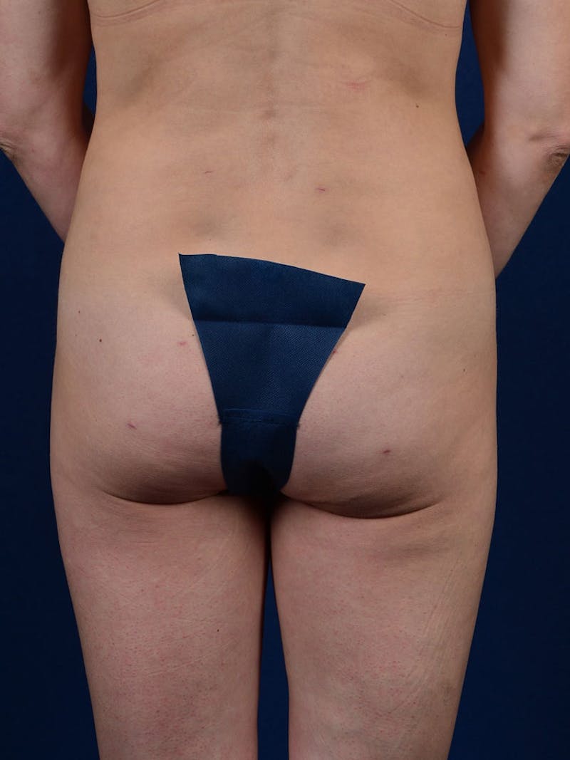 Brazilian Buttock Lift Before & After Gallery - Patient 9421668 - Image 2