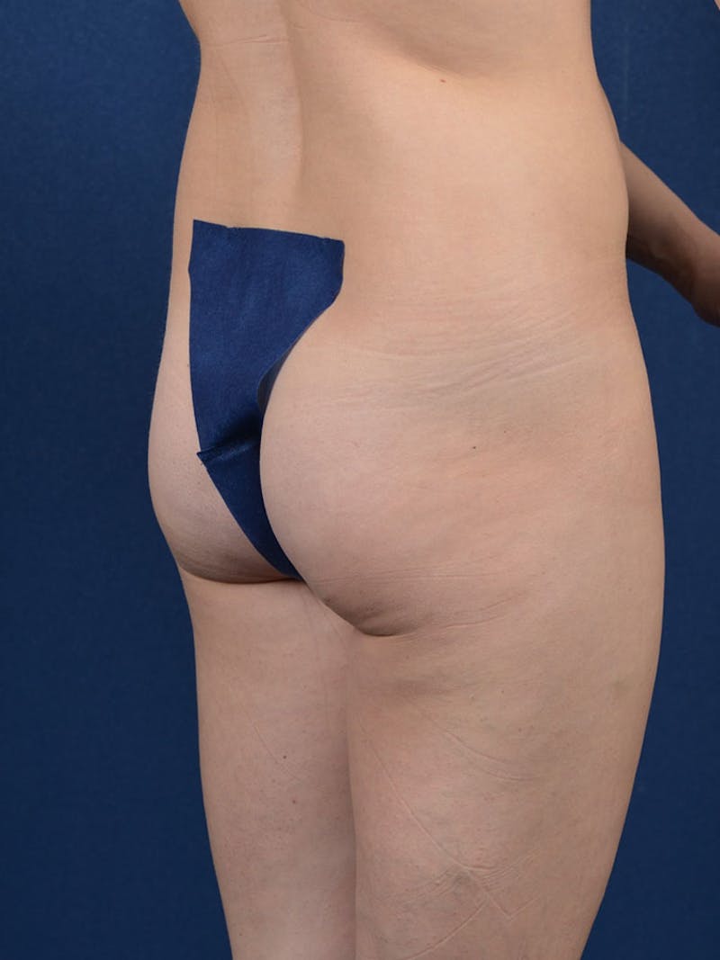 Brazilian Buttock Lift Before & After Gallery - Patient 9421668 - Image 5