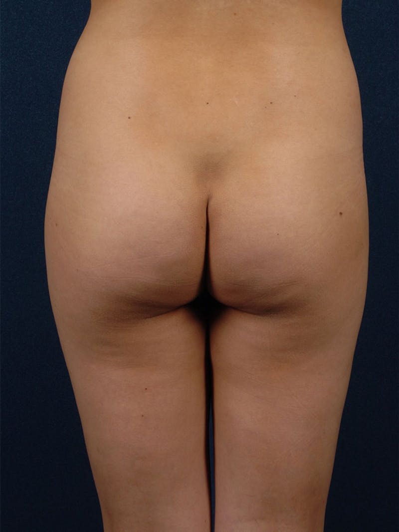 Brazilian Buttock Lift Before & After Gallery - Patient 9421672 - Image 1