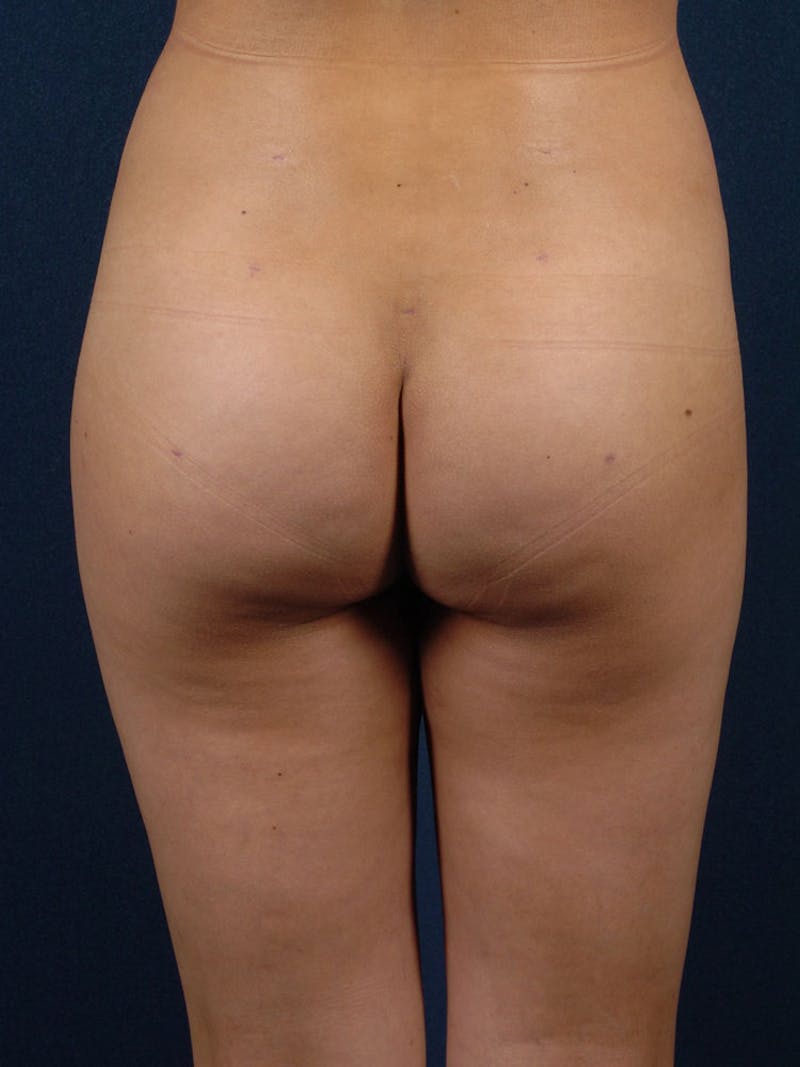 Brazilian Buttock Lift Before & After Gallery - Patient 9421672 - Image 2