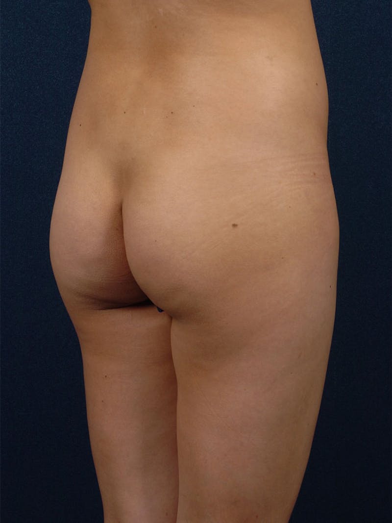 Brazilian Buttock Lift Before & After Gallery - Patient 9421672 - Image 3