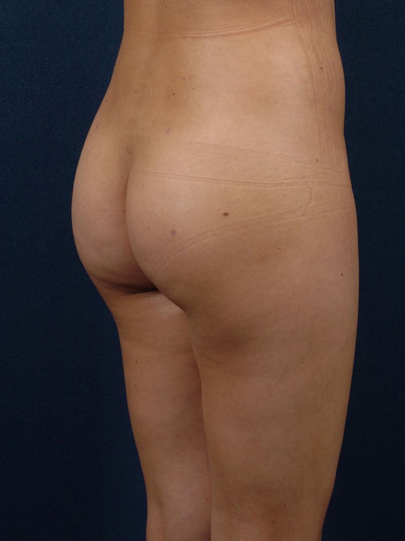 Brazilian Buttock Lift Before & After Gallery - Patient 9421672 - Image 4