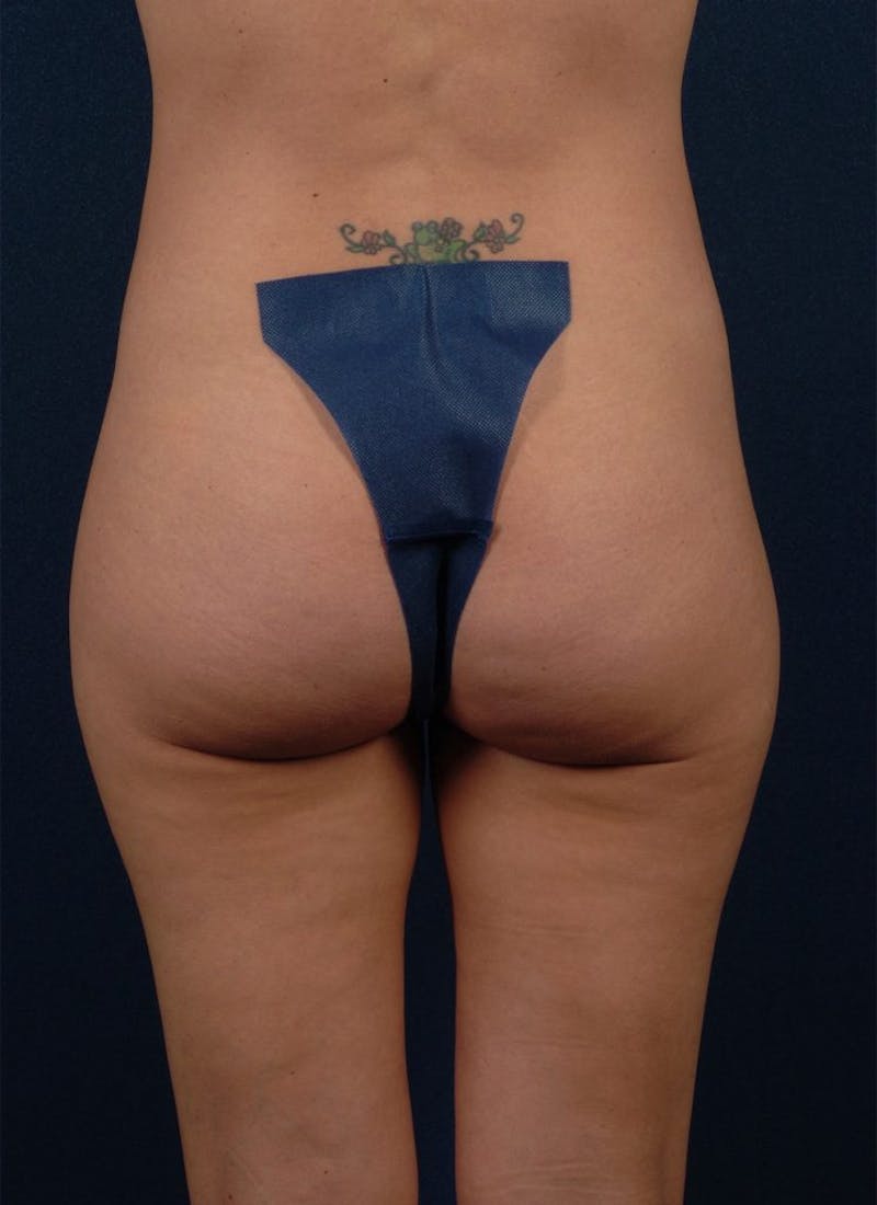 Brazilian Buttock Lift Before & After Gallery - Patient 9421678 - Image 1