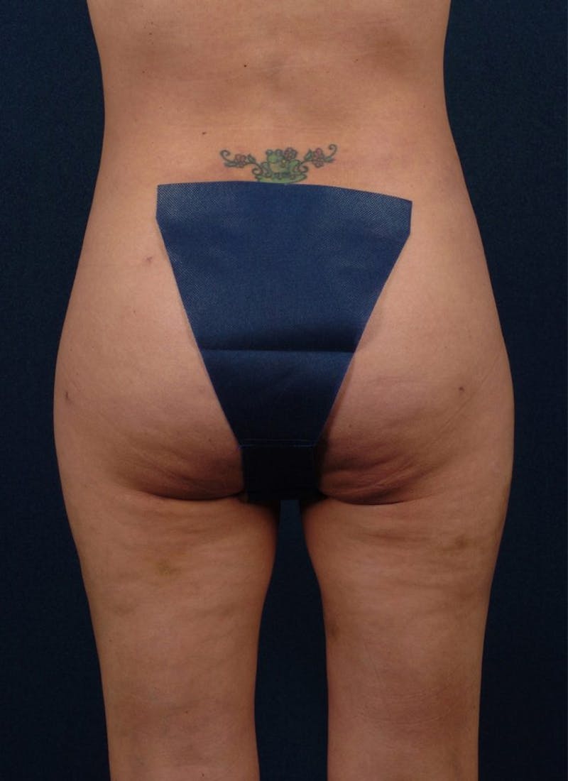 Brazilian Buttock Lift Before & After Gallery - Patient 9421678 - Image 2