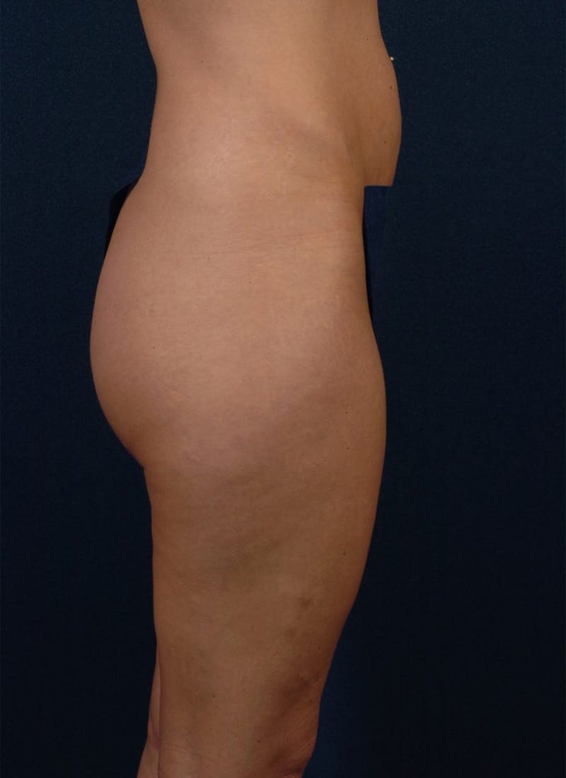 Brazilian Buttock Lift Before & After Gallery - Patient 9421678 - Image 3