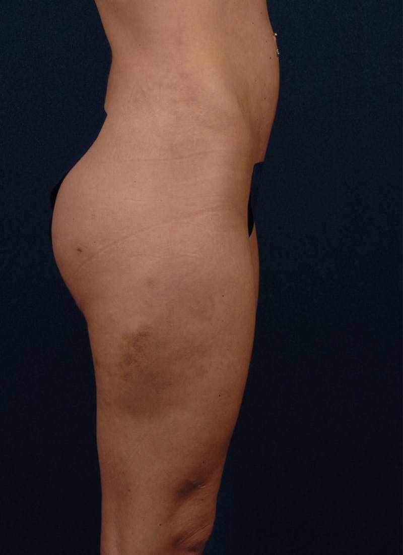 Brazilian Buttock Lift Before & After Gallery - Patient 9421678 - Image 4
