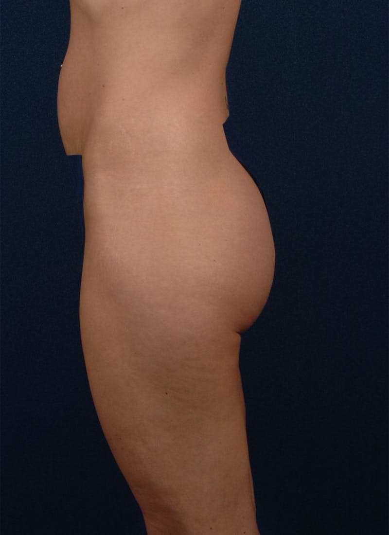 Brazilian Buttock Lift Before & After Gallery - Patient 9421678 - Image 5