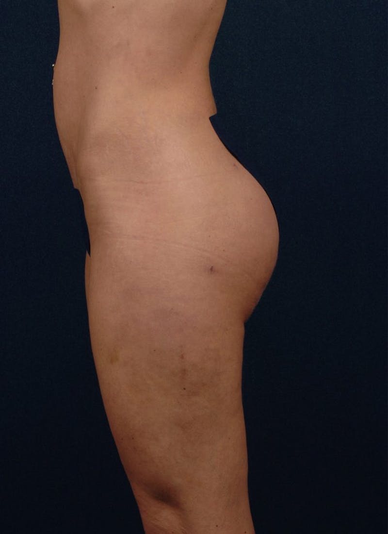 Brazilian Buttock Lift Before & After Gallery - Patient 9421678 - Image 6