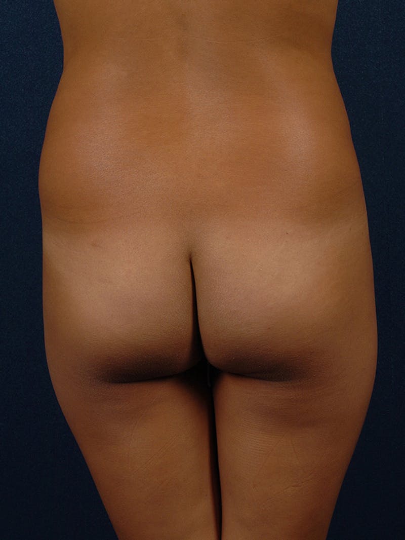 Brazilian Buttock Lift Before & After Gallery - Patient 9421683 - Image 1