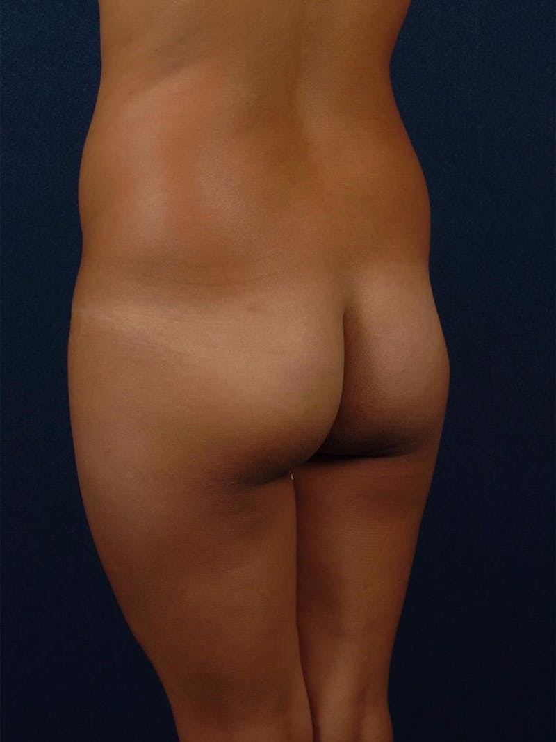 Brazilian Buttock Lift Gallery - Patient 9421683 - Image 3