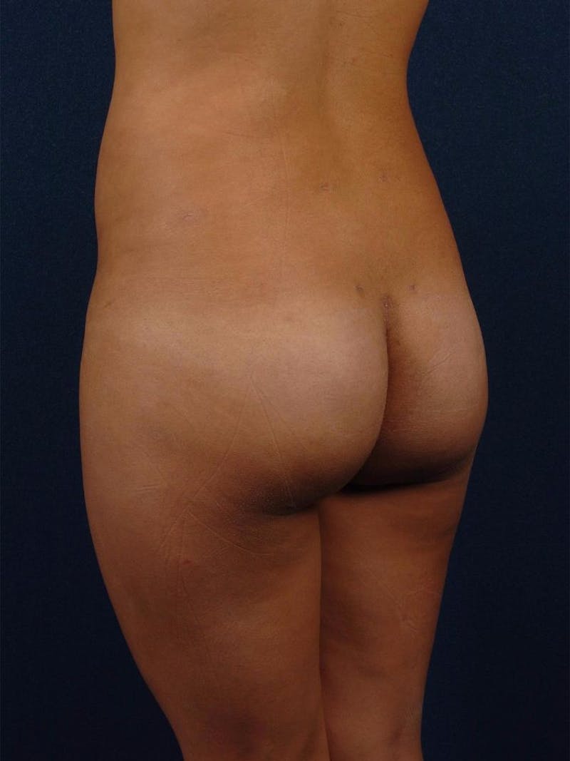 Brazilian Buttock Lift Before & After Gallery - Patient 9421683 - Image 4